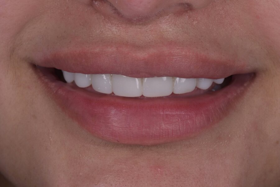 After Composite Bonding at Seren Dental