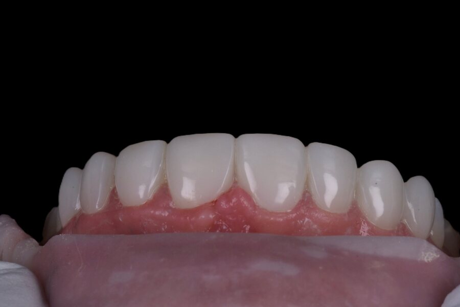 After Composite Bonding at Seren Dental