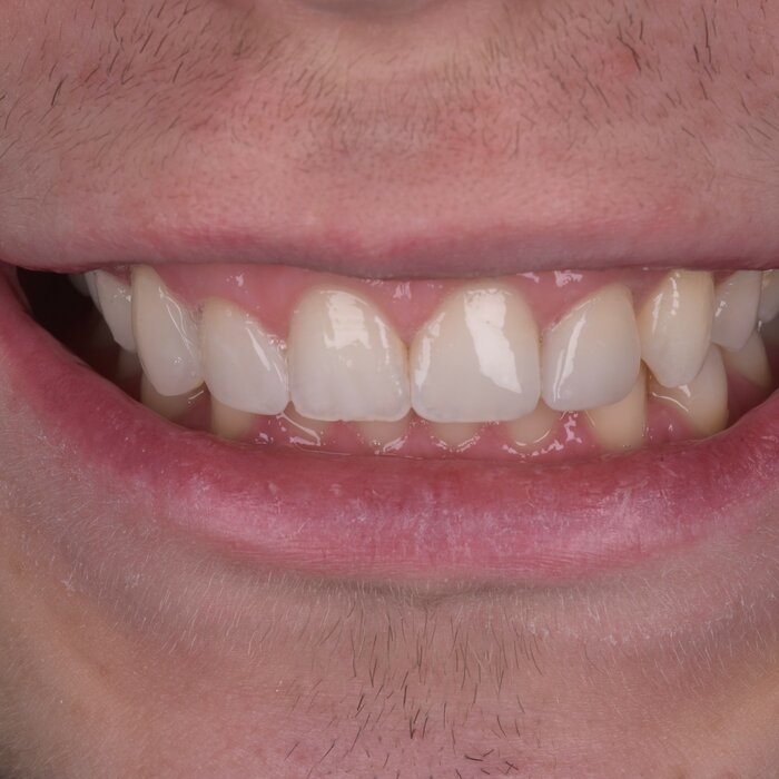 After composite bonding at Seren Dental