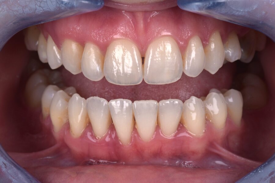 After Invisalign, Tooth Whitening at Seren Dental