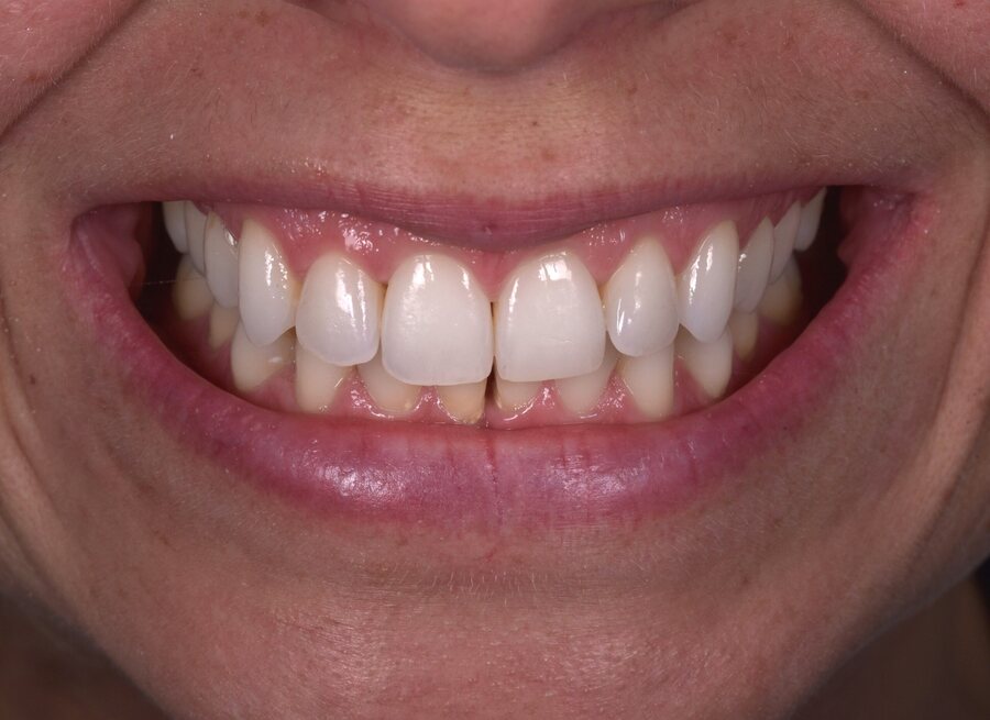 After Invisalign, Tooth Whitening at Seren Dental