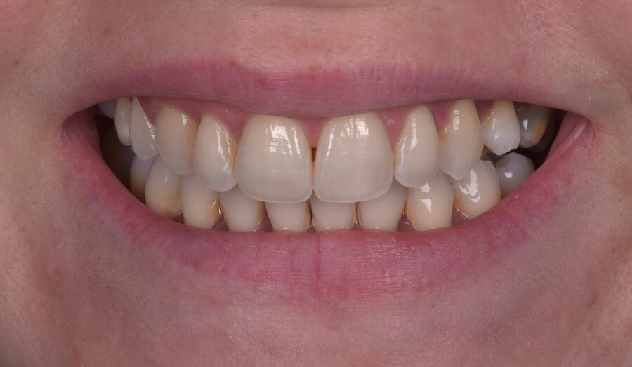 After Invisalign, Tooth Whitening at Seren Dental