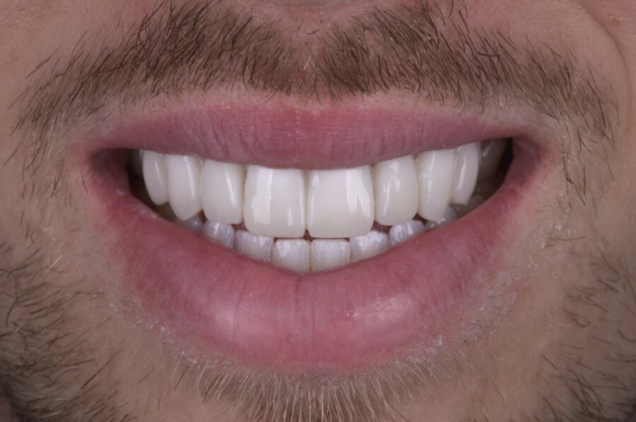 After Invisalign, Tooth Whitening, Composite Bonding at Seren Dental
