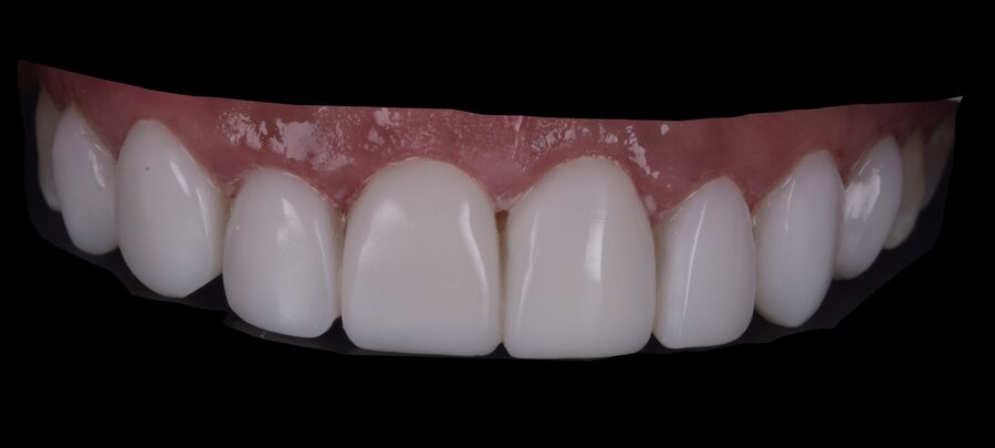 After Invisalign, Tooth Whitening, Composite Bonding at Seren Dental