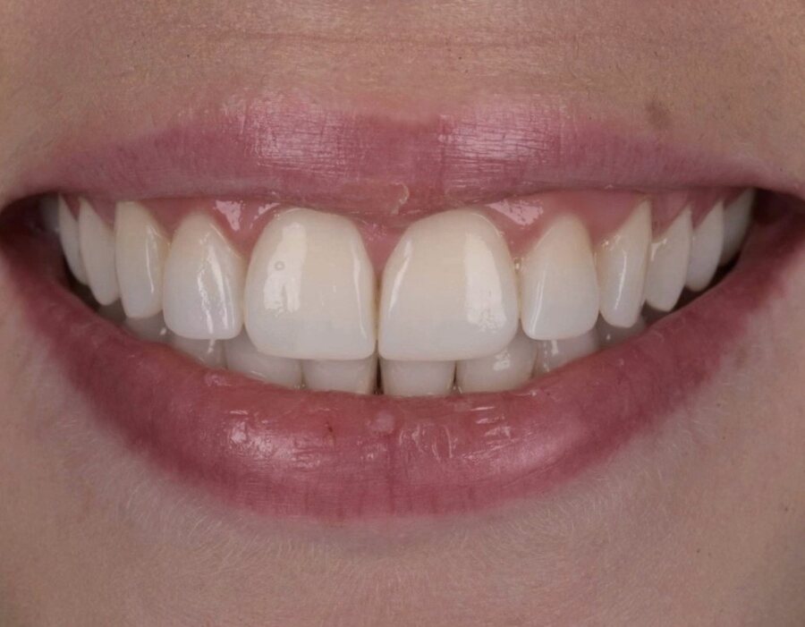 After Invisalign, Tooth Whitening, Composite Bonding at Seren Dental