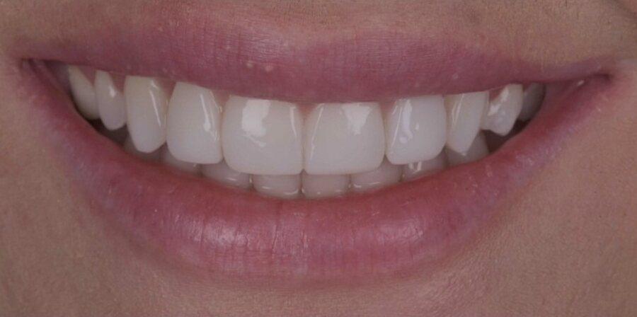 After Invisalign, Tooth Whitening, Composite Bonding at Seren Dental