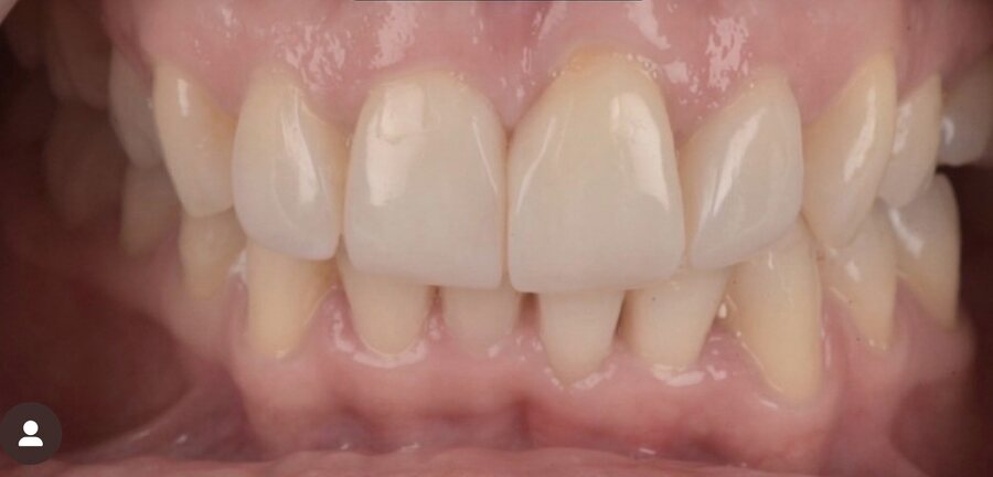 After Invisalign, Tooth Whitening, Composite Bonding at Seren Dental
