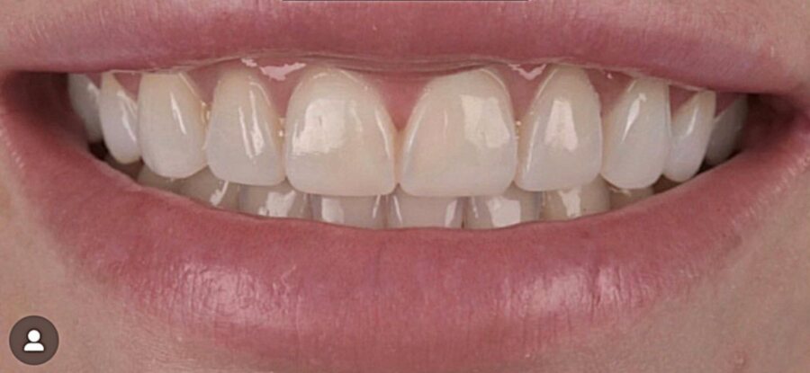 After Invisalign, Tooth Whitening, Composite Bonding at Seren Dental