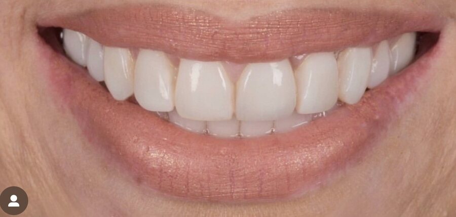 After Invisalign, Tooth Whitening, Composite Bonding at Seren Dental