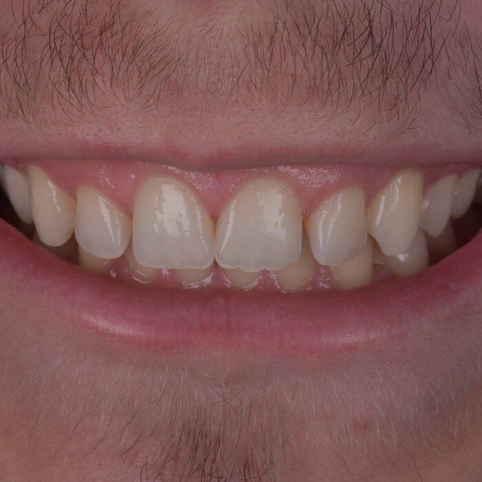 After teeth whitening, scale and polish at Seren Dental
