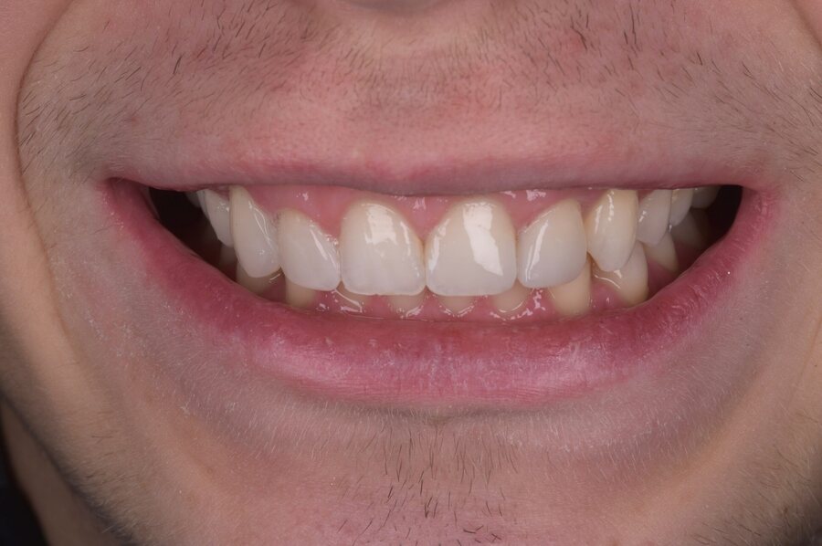 After Tooth Whitening, Composite Bonding at Seren Dental