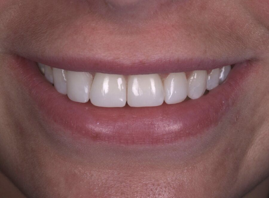 After Tooth Whitening, Composite Bonding at Seren Dental