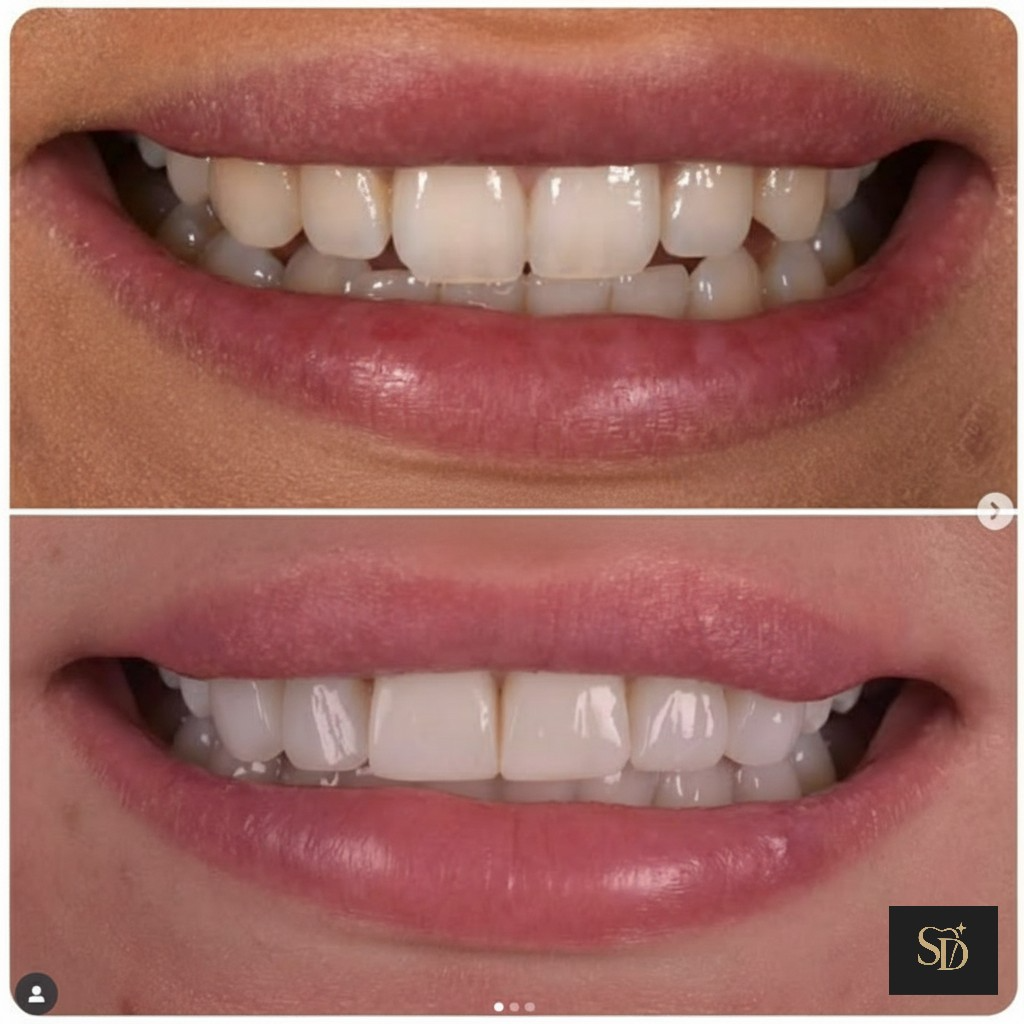 Before and after smile transformation at Seren Dental, Cardiff — patient 3