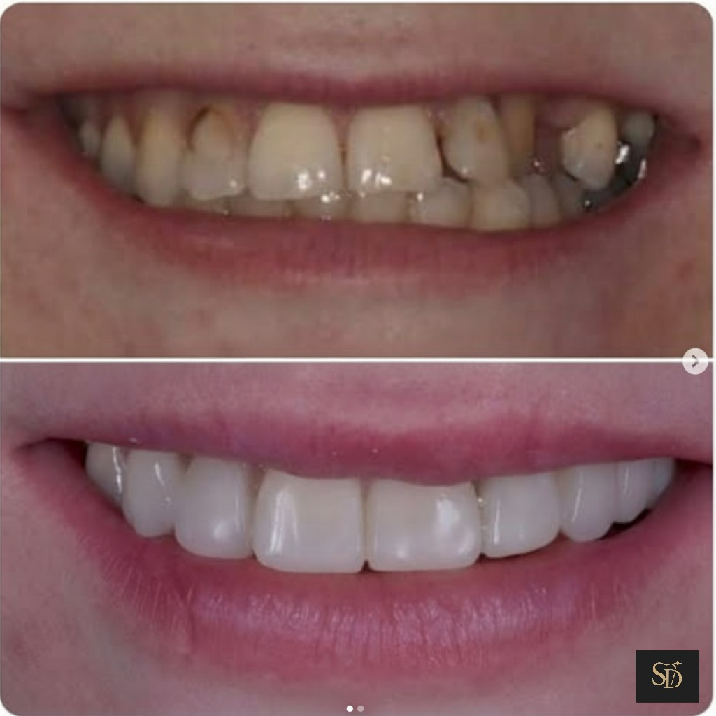 Before and after smile transformation at Seren Dental, Cardiff — patient 6