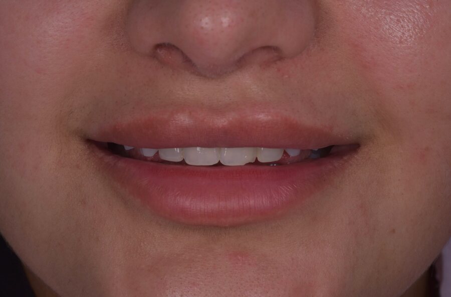 Before Composite Bonding at Seren Dental