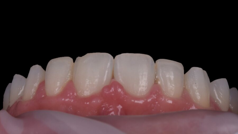 Before Composite Bonding at Seren Dental