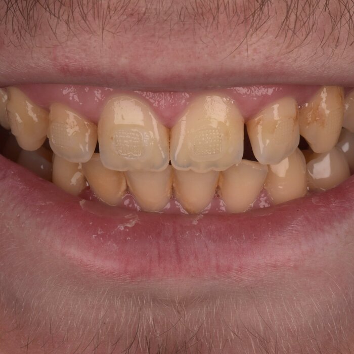 Before teeth whitening at Seren Dental
