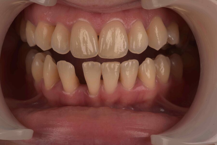 Before Invisalign, Tooth Whitening at Seren Dental