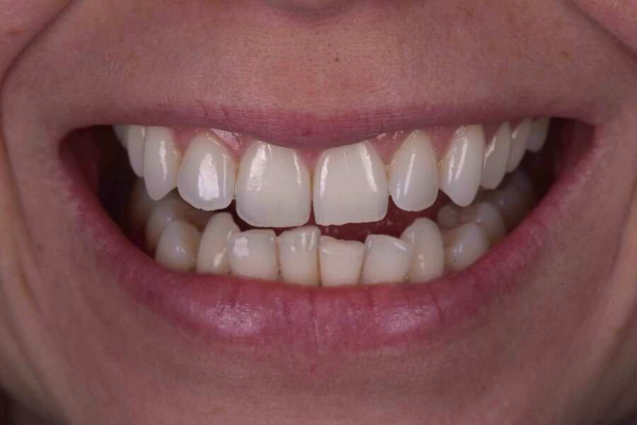Before Invisalign, Tooth Whitening at Seren Dental