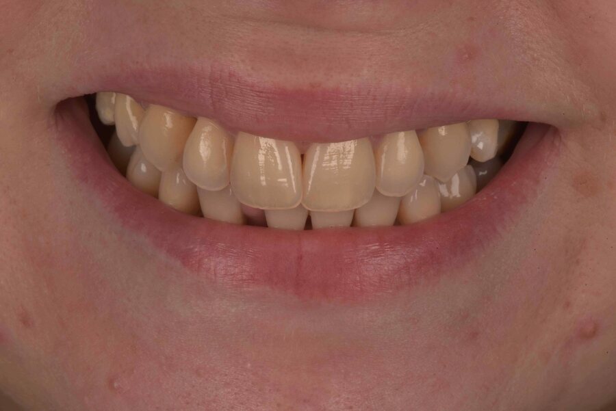 Before Invisalign, Tooth Whitening at Seren Dental