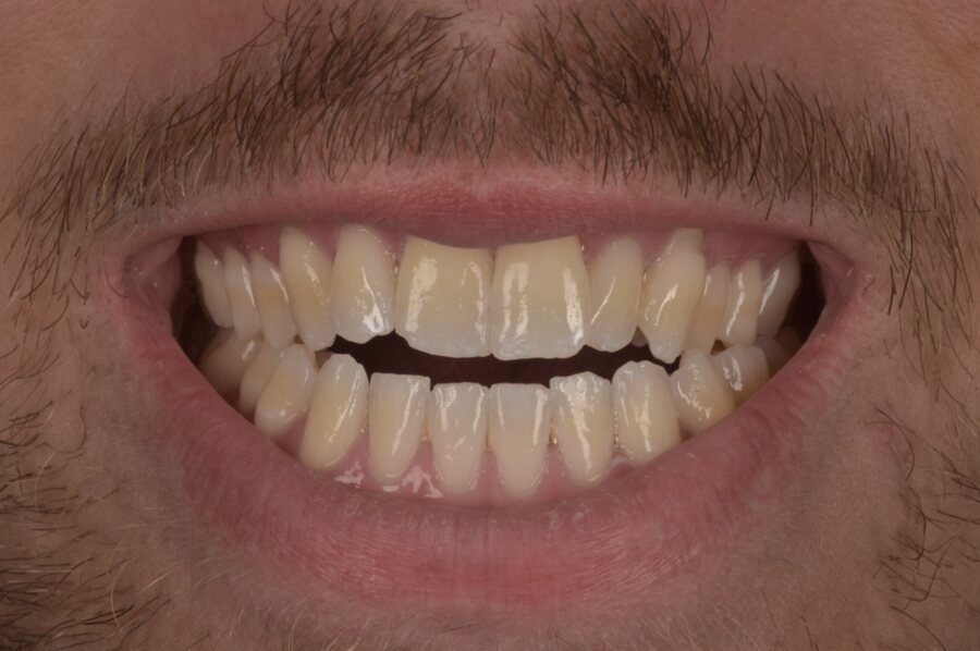 Before Invisalign, Tooth Whitening, Composite Bonding at Seren Dental