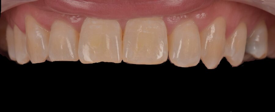 Before Invisalign, Tooth Whitening, Composite Bonding at Seren Dental