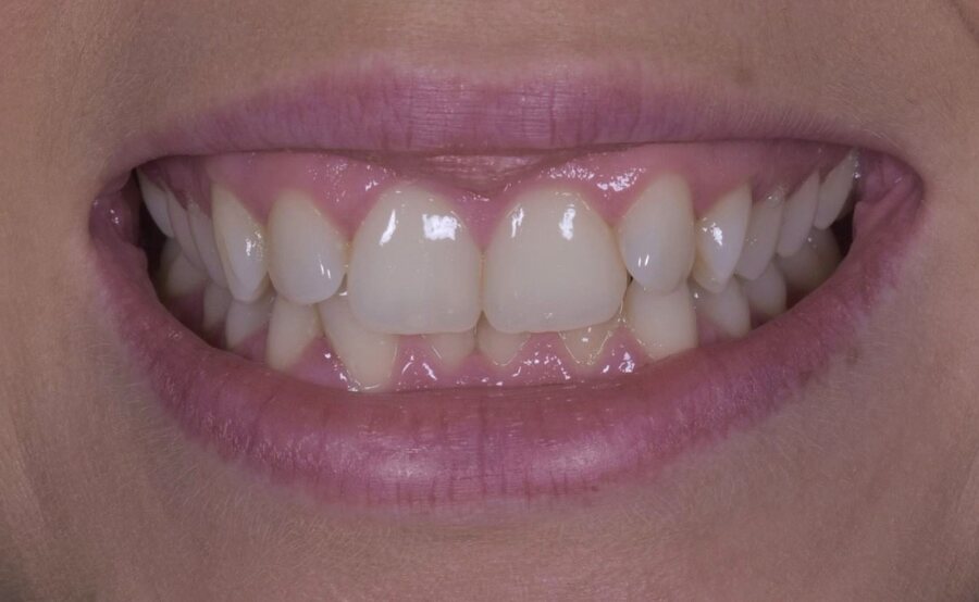 Before Invisalign, Tooth Whitening, Composite Bonding at Seren Dental