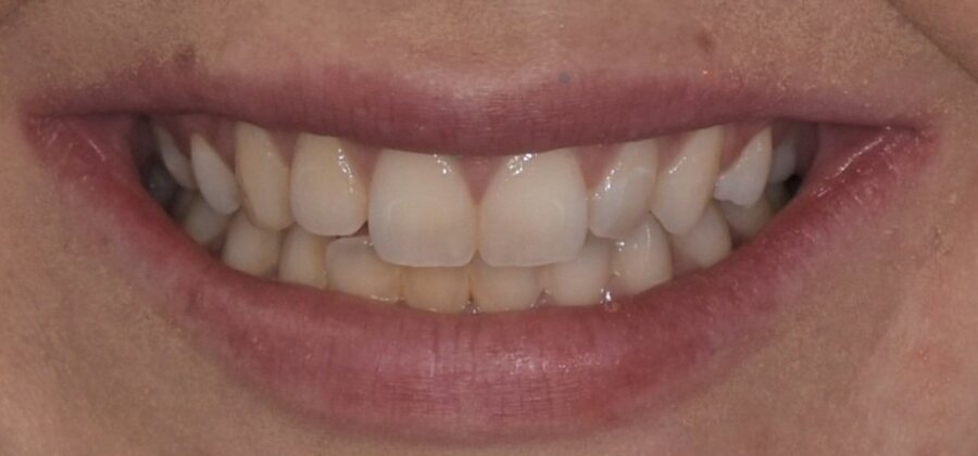 Before Invisalign, Tooth Whitening, Composite Bonding at Seren Dental