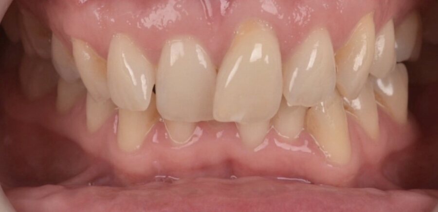 Before Invisalign, Tooth Whitening, Composite Bonding at Seren Dental
