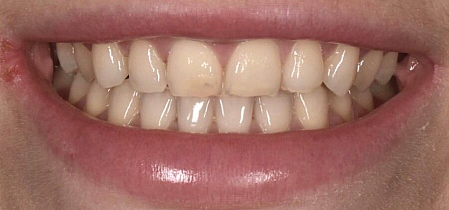 Before Invisalign, Tooth Whitening, Composite Bonding at Seren Dental