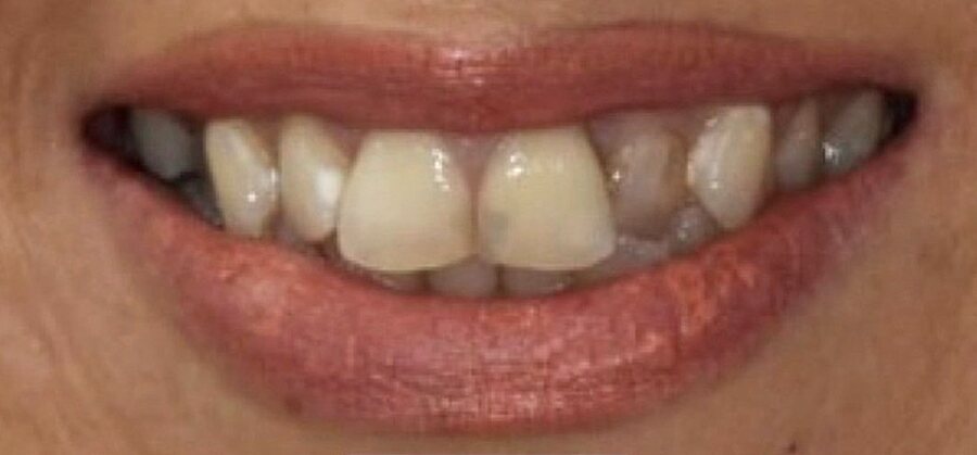 Before Invisalign, Tooth Whitening, Composite Bonding at Seren Dental