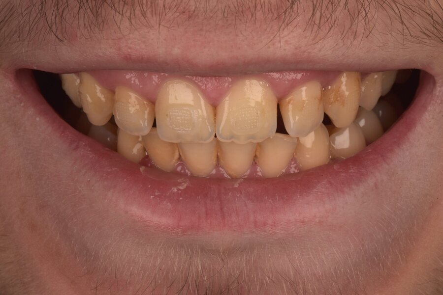 Before Tooth Whitening, Composite Bonding at Seren Dental