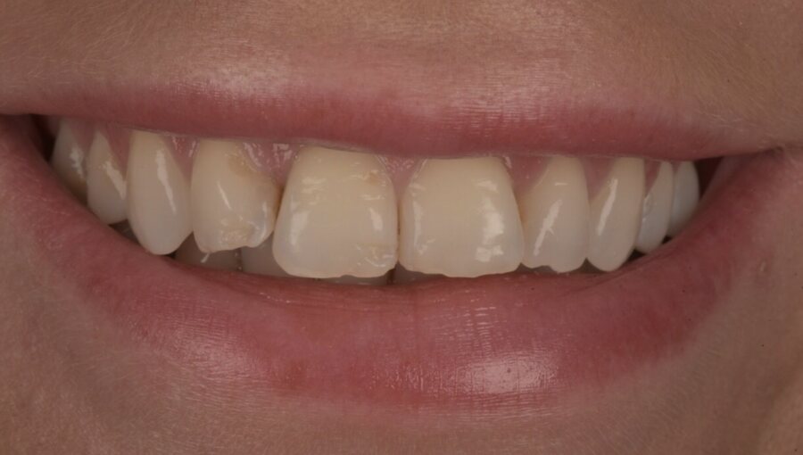 Before Tooth Whitening, Composite Bonding at Seren Dental