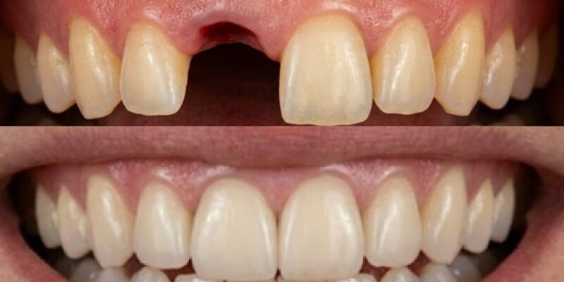 Dental implants at Seren Dental