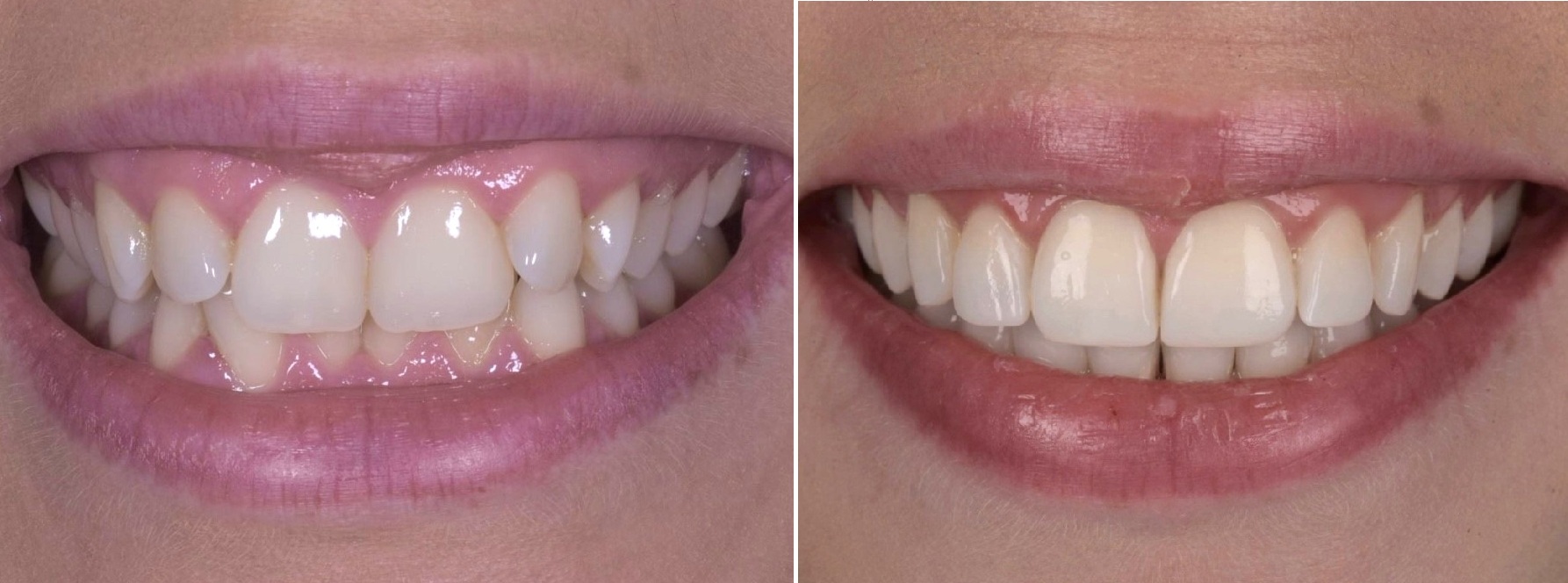 Invisalign before and after at Seren Dental
