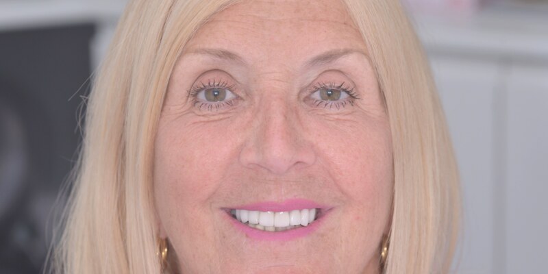 Porcelain veneers results at Seren Dental